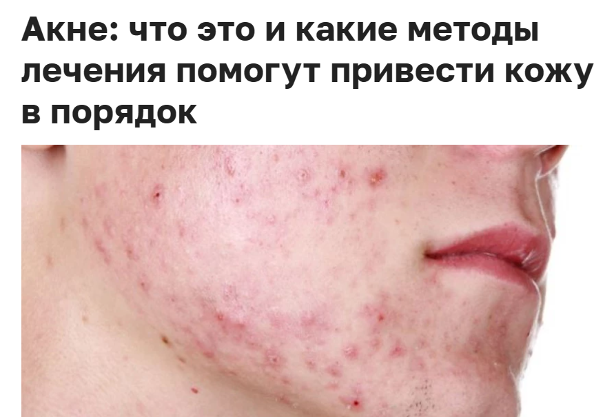 Akne2